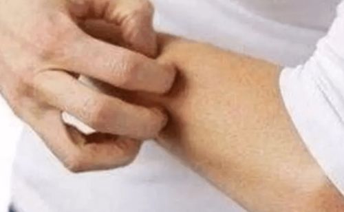 疤痕体质的疤是什么样的 疤痕体质的疤是什么样的