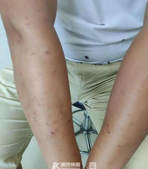 得了湿疹哪些方面 得了湿疹哪些方面