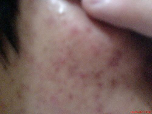 灰指甲的症状在指甲上的表现众多 灰指甲的症状在指甲上的表现众多