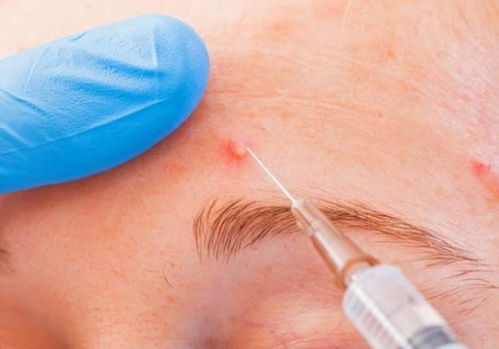 去黄疸的中药有哪些 去黄疸的中药有哪些