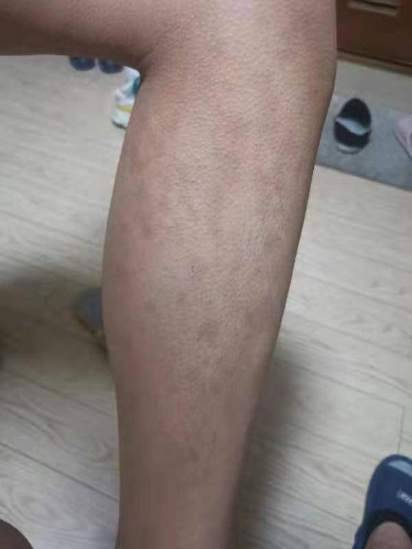 手臂上出现小红点是怎么回事 手臂上出现小红点是怎么回事