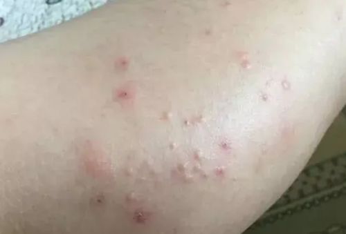 牛皮癣和湿疹有什么不同之处 牛皮癣和湿疹有什么不同之处