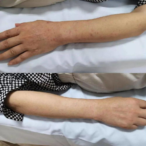 孕妇得了牛皮癣怎么办好 孕妇得了牛皮癣怎么办好