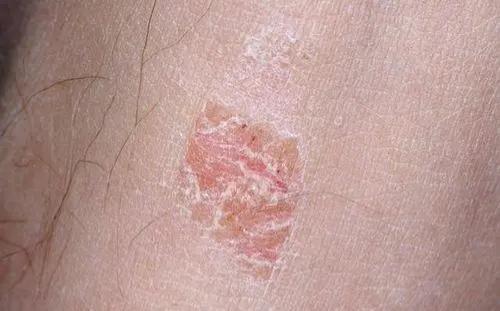 湿疹可以擦什么药 湿疹可以擦什么药