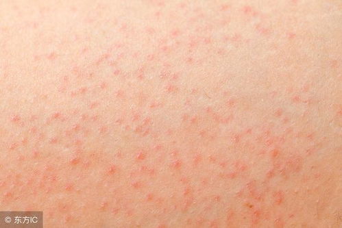 脚气的防治方法有哪些 脚气的防治方法有哪些