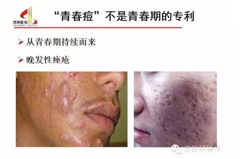 生活中的一些小习惯也会诱发痤疮 生活中的一些小习惯也会诱发痤疮