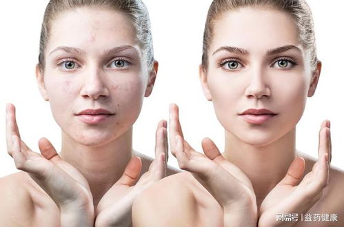 人工荨麻疹的应注意哪些事项 人工荨麻疹的应注意哪些事项