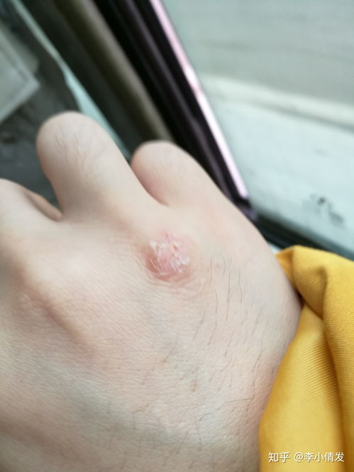 脸上疱疹是什么原因引起 脸上疱疹是什么原因引起