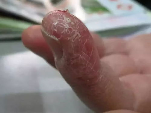 北京皮肤科好的医院是那家为什么荨麻疹会反复发作 北京皮肤科好的医院是那家为什么荨麻疹会反复发作