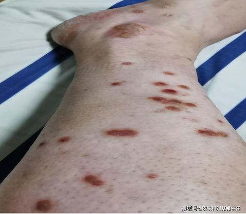 过敏性荨麻疹是否会出现传染倾向呢 过敏性荨麻疹是否会出现传染倾向呢