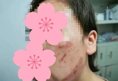 阴囊湿疹的最主要症状 阴囊湿疹的最主要症状