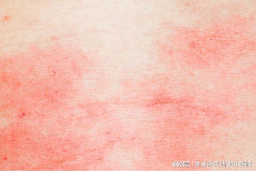 发生灰指甲是怎么的 发生灰指甲是怎么的