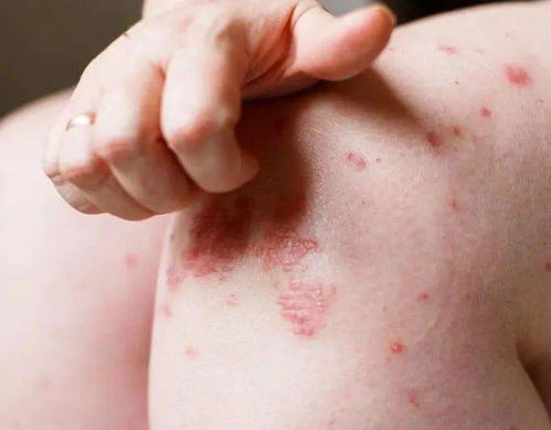 尿道炎怎么治能治好 尿道炎怎么治能治好