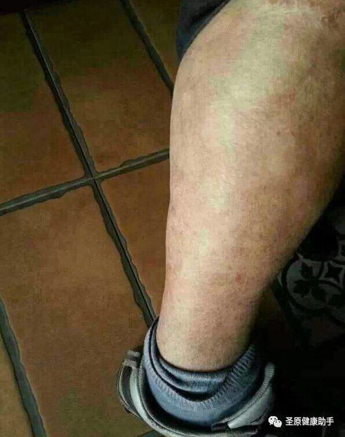 剃腋毛会加重狐臭吗 剃腋毛会加重狐臭吗