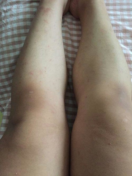 慢性荨麻疹越来越严重怎么办 慢性荨麻疹越来越严重怎么办