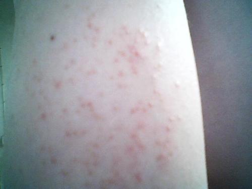 口腔单纯疱疹性病毒感染会传染吗 口腔单纯疱疹性病毒感染会传染吗