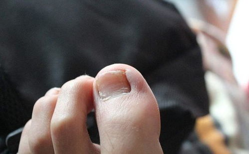 痤疮发病造成哪些危害 痤疮发病造成哪些危害