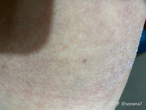 慢性湿疹的饮食疗法有 慢性湿疹的饮食疗法有