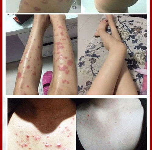 如何远离灰指甲 如何远离灰指甲