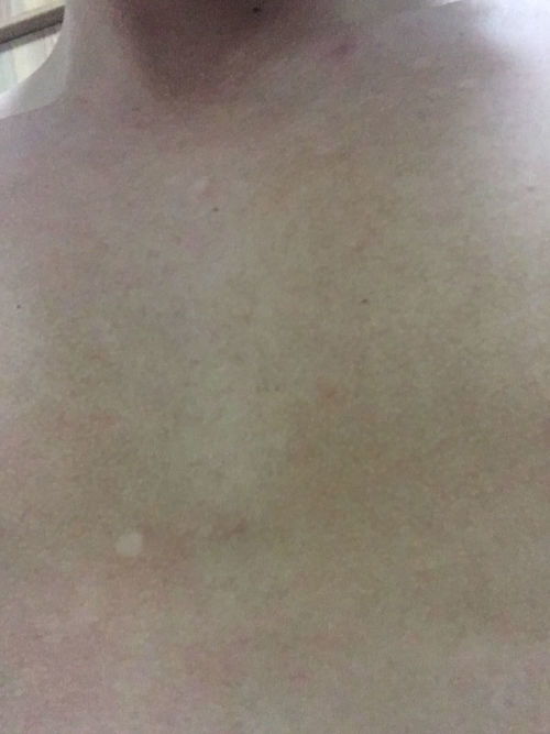 产生灰指甲后会带来哪些影响 产生灰指甲后会带来哪些影响