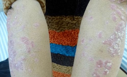 痤疮到底是什么 痤疮的直接原因 痤疮到底是什么 痤疮的直接原因