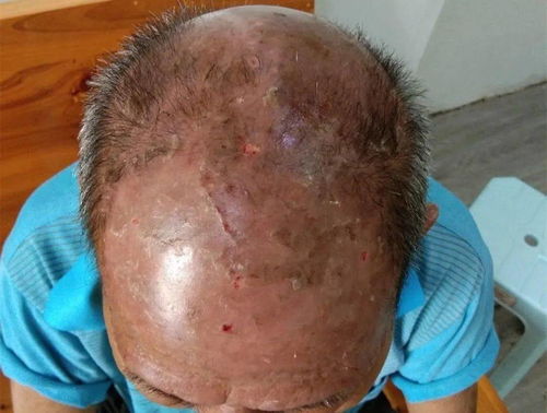 石家庄牛皮癣名每日石家庄牛皮癣 石家庄牛皮癣名每日石家庄牛皮癣