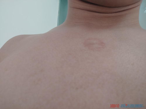 灰指甲要把整个指甲拔掉吗 灰指甲要多久能治好 灰指甲要把整个指甲拔掉吗 灰指甲要多久能治好