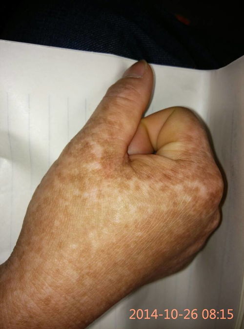 灰指甲具体的危害有哪些 灰指甲要怎么治疗 灰指甲具体的危害有哪些 灰指甲要怎么治疗