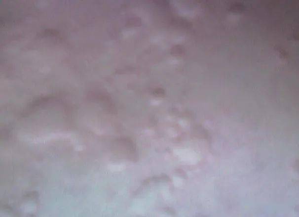 舌头痛是怎么回事 舌头痛是怎么回事