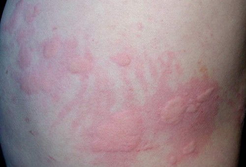 牛皮癣有哪些危害表现 牛皮癣有哪些危害表现