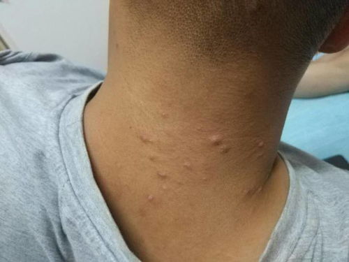 治疗灰指甲的民间小偏方 治疗灰指甲的民间小偏方