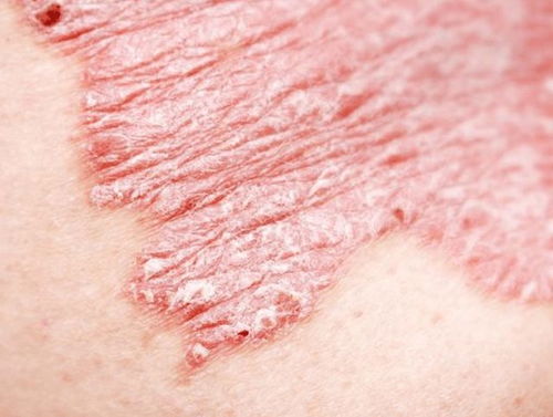 儿童应该另类荨麻疹 儿童应该另类荨麻疹