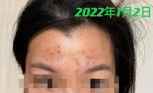 为何会患上脚气呢 为何会患上脚气呢