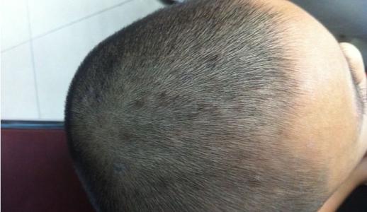 灰指甲为什么久治不愈 灰指甲为什么久治不愈