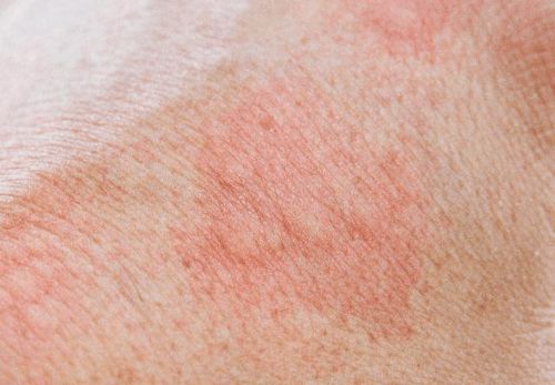 灰指甲认识误区有哪些 灰指甲认识误区有哪些