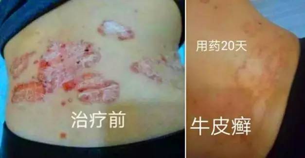 皮肤痒能吃鸡蛋吗 皮肤痒能吃鸡蛋吗