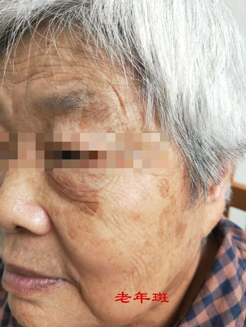 急性荨麻疹引起低血糖的治疗方法 急性荨麻疹引起低血糖的治疗方法