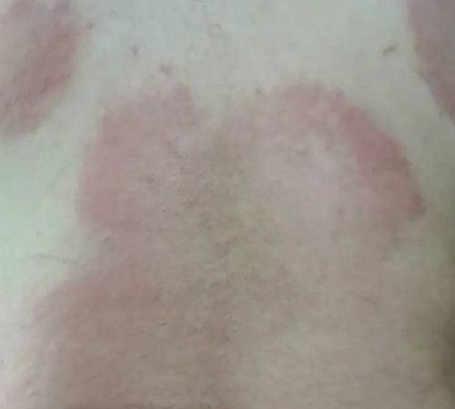 宝宝脸上起了好多湿疹 宝宝脸上起了好多湿疹