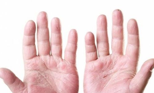 С��������ʪ���֢״����Щ