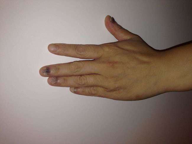 慢性荨麻疹痒不痒 慢性荨麻疹痒不痒