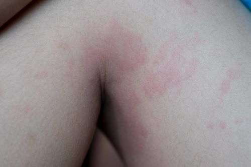 慢性创伤可灰指甲 慢性创伤可灰指甲