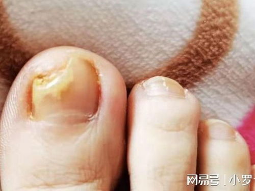 去皮肤科点痣可以用医保吗 去皮肤科点痣可以用医保吗