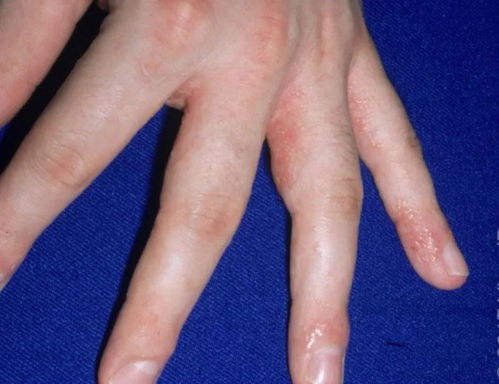 手部过敏性湿疹如何用药 手部过敏性湿疹如何用药