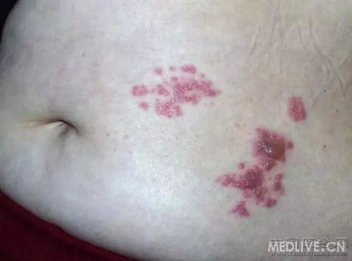 春分将至 祛湿防脚气 春分将至 祛湿防脚气