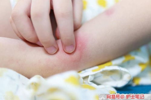 脚气怎么能根治呢 脚气怎么能根治呢