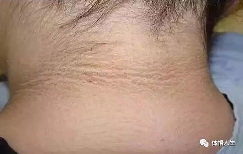 从哪些方面做好灰指甲的预防 从哪些方面做好灰指甲的预防