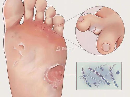 灰指甲有什么好的治疗方法呢 灰指甲有什么好的治疗方法呢