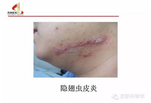 ��Ⱦ��ʪ����Ƥ�����Ԥ��