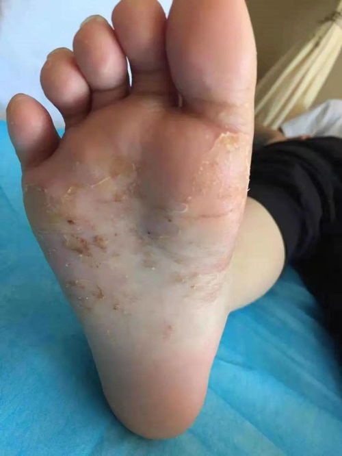 沧州哪家牛皮癣比较好 银屑病多少时间变成关节型银屑病 沧州哪家牛皮癣比较好 银屑病多少时间变成关节型银屑病