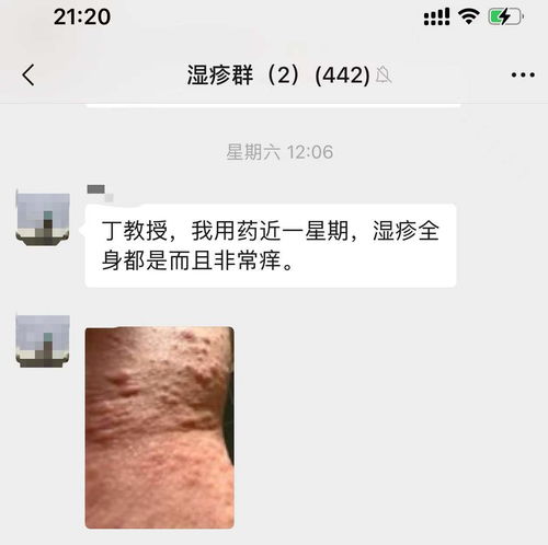 男性阴囊湿疹治疗方法是什么 男性阴囊湿疹治疗方法是什么